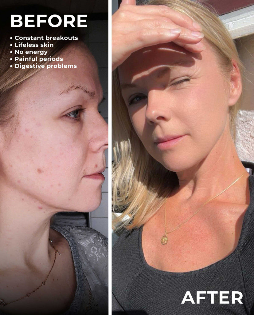 Before and after results from using The Rescue – supports acne-prone skin through internal balance and gut reset.